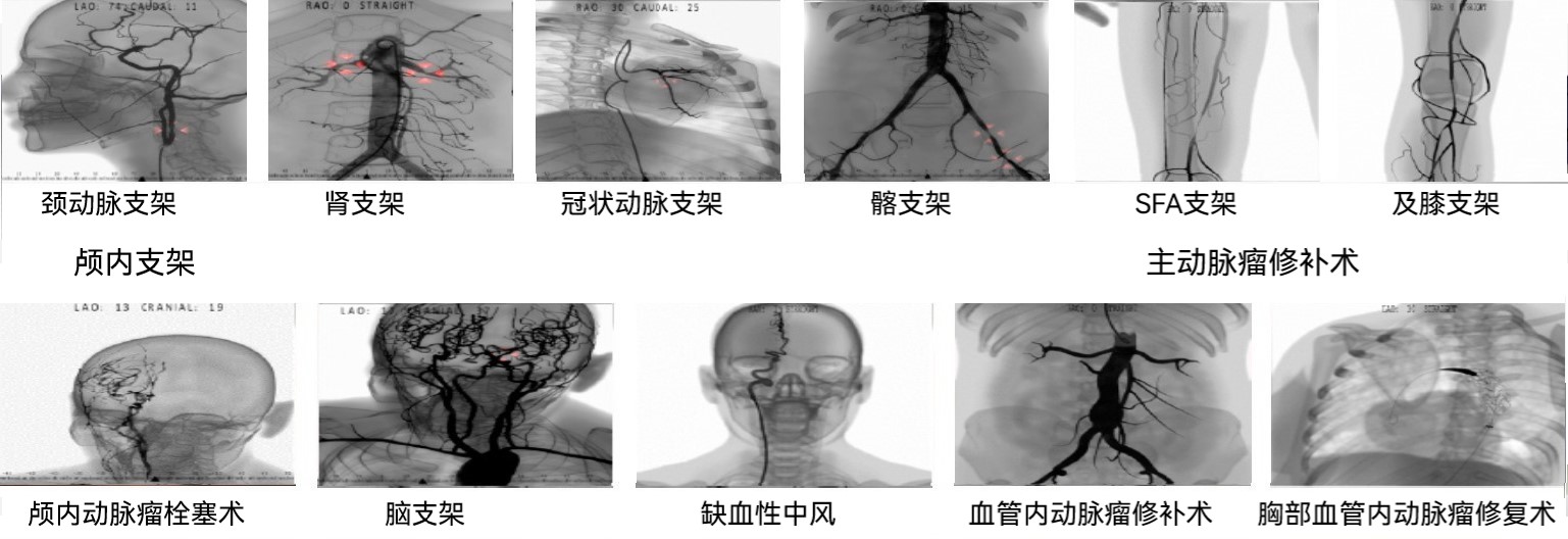 球囊血管成形術(shù)和支架置入
